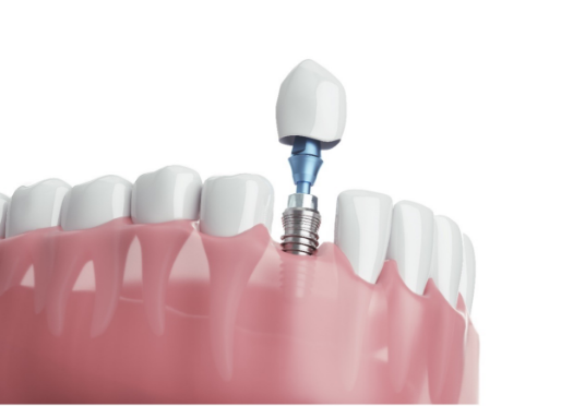 入れ歯に変わる治療法であるインプラントとの比較